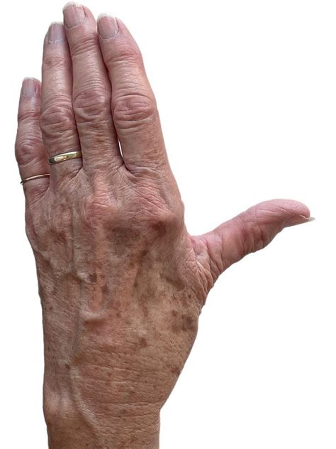 Artrose duim operatie